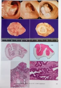 Foto de Cáncer temprano o incipiente de Colon