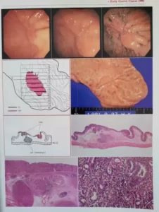 Foto de cáncer temprano o incipiente de estómago