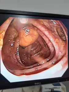 Vista interna del examen de Colonoscopia