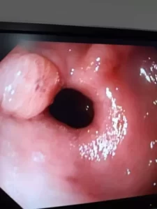 Vista interna del examen de Endoscopia Digestiva Alta