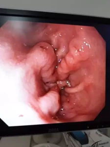 Vista interna del examen de Endoscopia Digestiva Alta