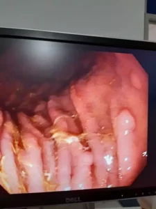 Vista interna del examen de Endoscopia Digestiva Alta