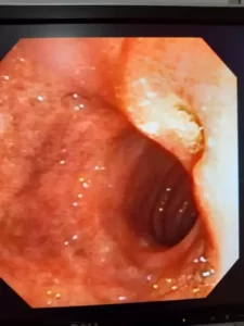 Vista interna del examen de Endoscopia Digestiva Alta