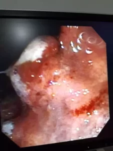 Vista interna del examen de Endoscopia Digestiva Alta