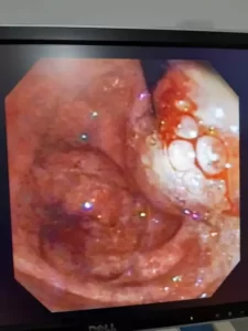 Vista interna del examen de Endoscopia Digestiva Alta